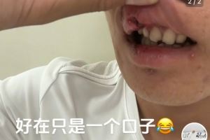 玉昆后卫晒受伤照:提前换下因争头球撞到了 视野模糊看不清&头晕